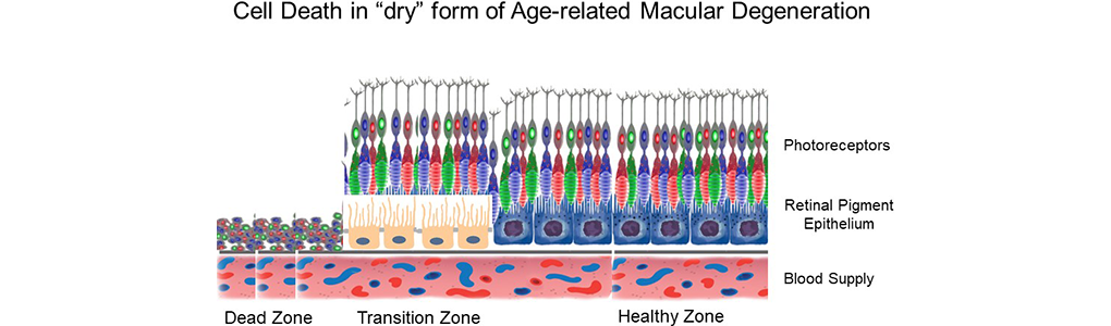 Cell death in dry-form of Age-related macular degeneration